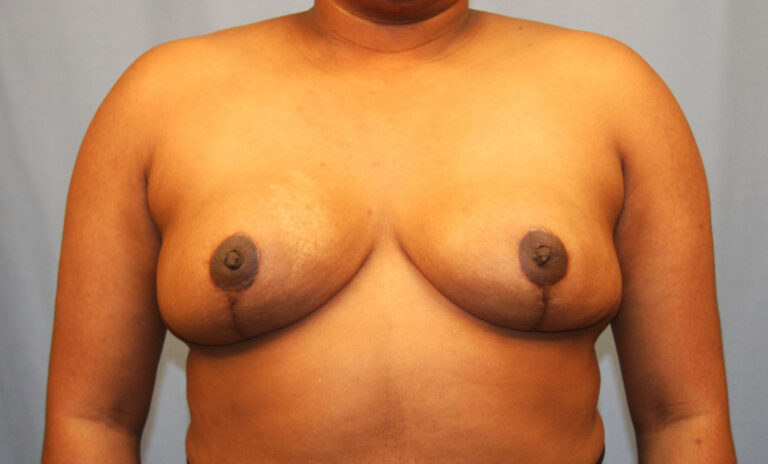 After Image: Breast Reduction - front