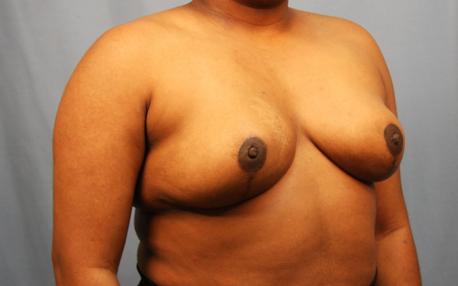 After Image: Breast Reduction - right-front-oblique