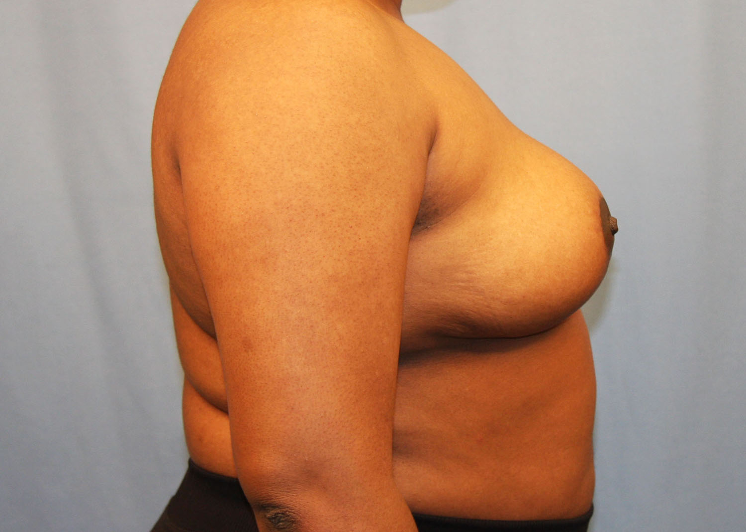 After Image: Breast Reduction - right-side