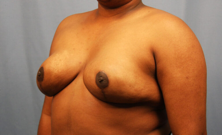 After Image: Breast Reduction - left-front-oblique
