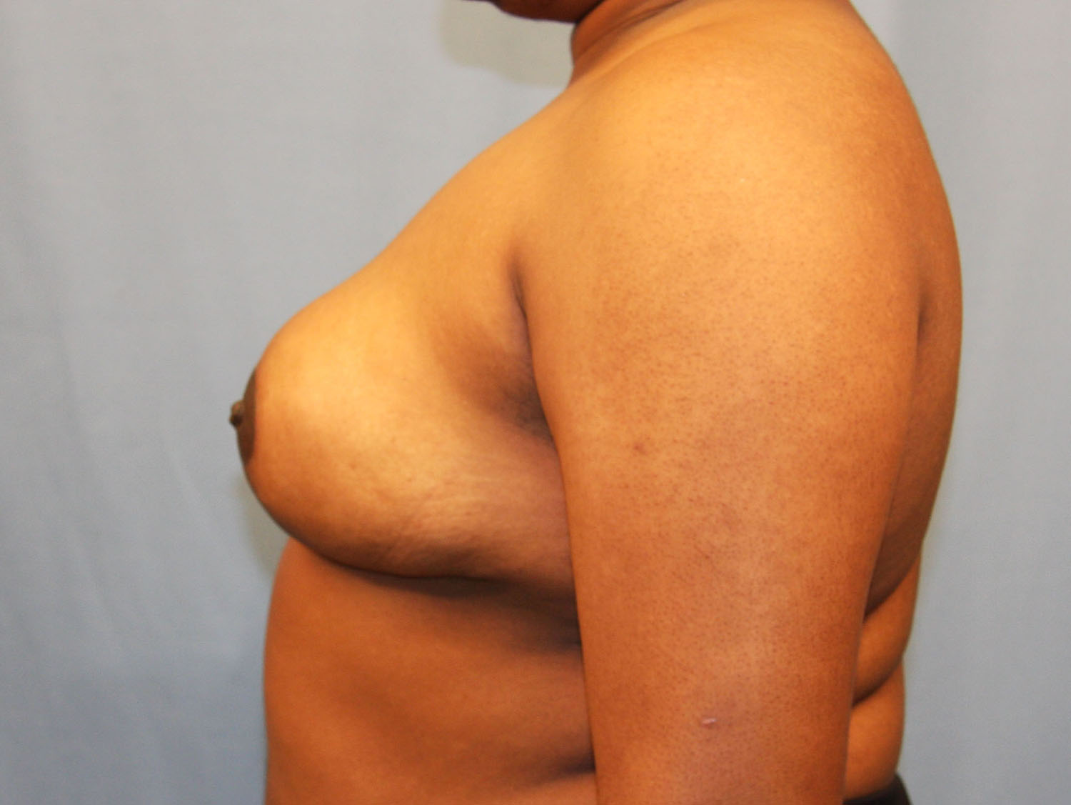 After Image: Breast Reduction - left-side