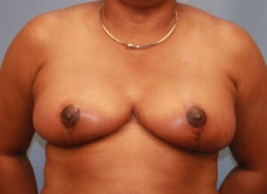 After Image: Breast Reduction