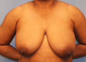 Before Image: Breast Reduction
