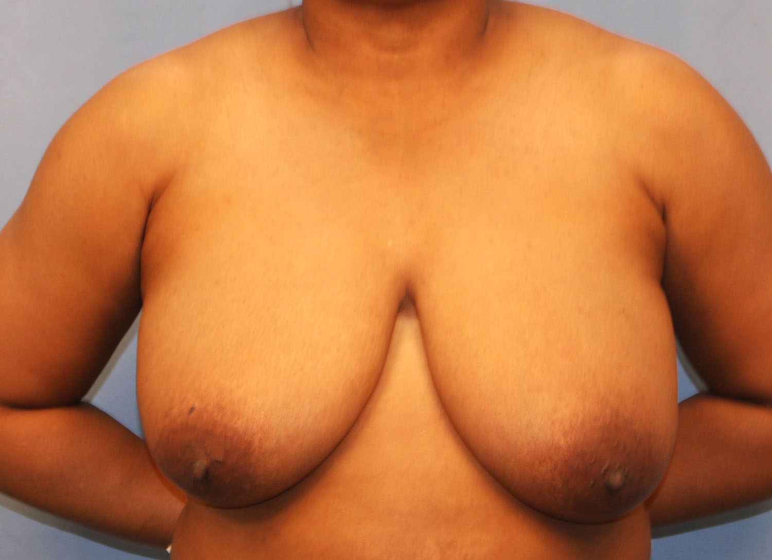 Before Image: Breast Reduction - front
