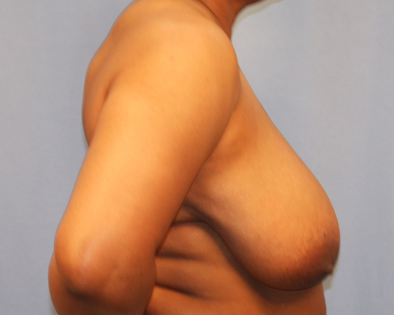 Before Image: Breast Reduction - right-side