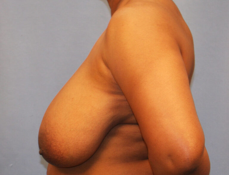 Before Image: Breast Reduction - left-side