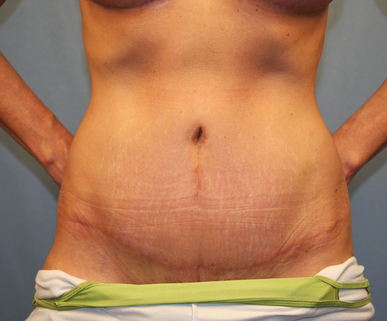 After Image: Tummy Tuck - front