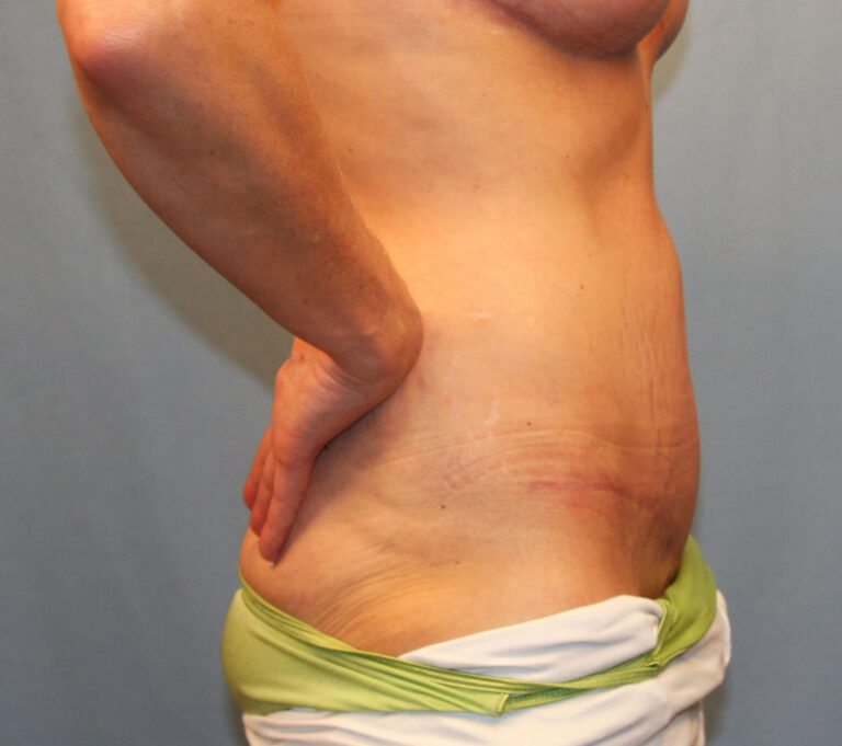 After Image: Tummy Tuck - right-side