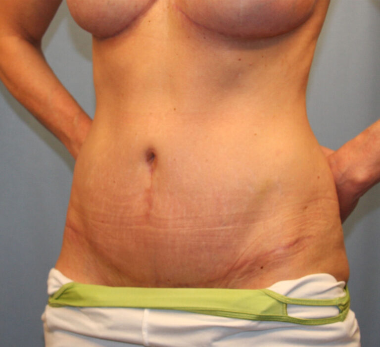 After Image: Tummy Tuck - left-front-oblique