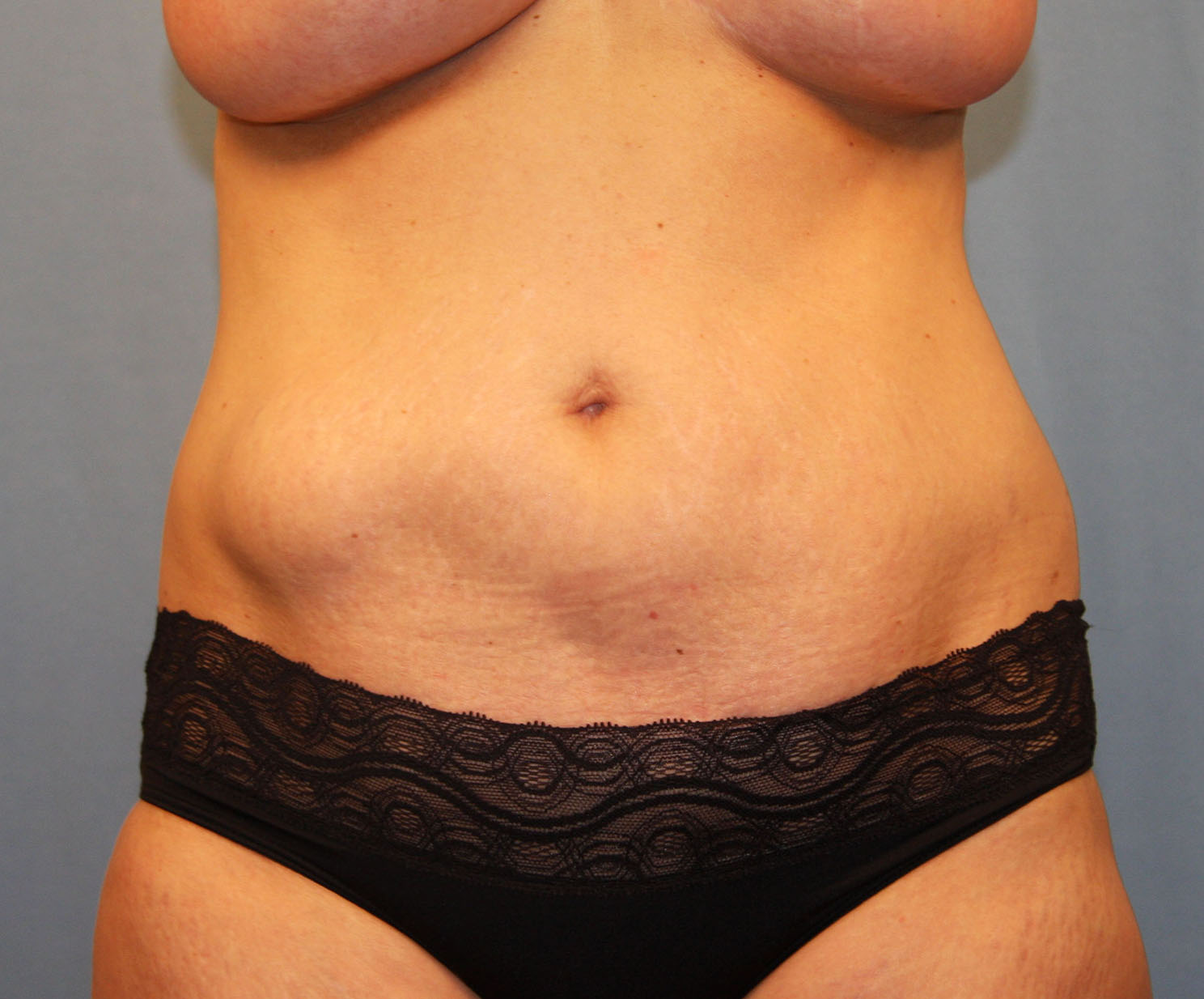 Before Image: Tummy Tuck - front