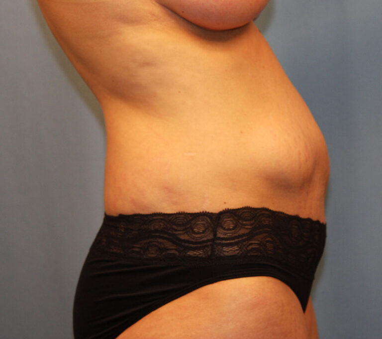 Before Image: Tummy Tuck - right-side