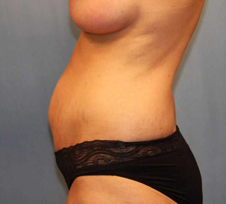 Before Image: Tummy Tuck - left-side