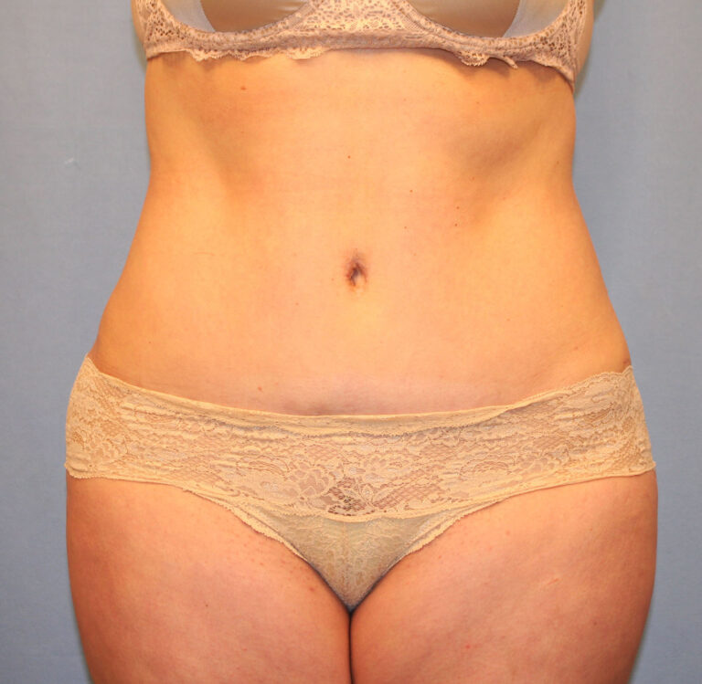 After Image: Tummy Tuck - front