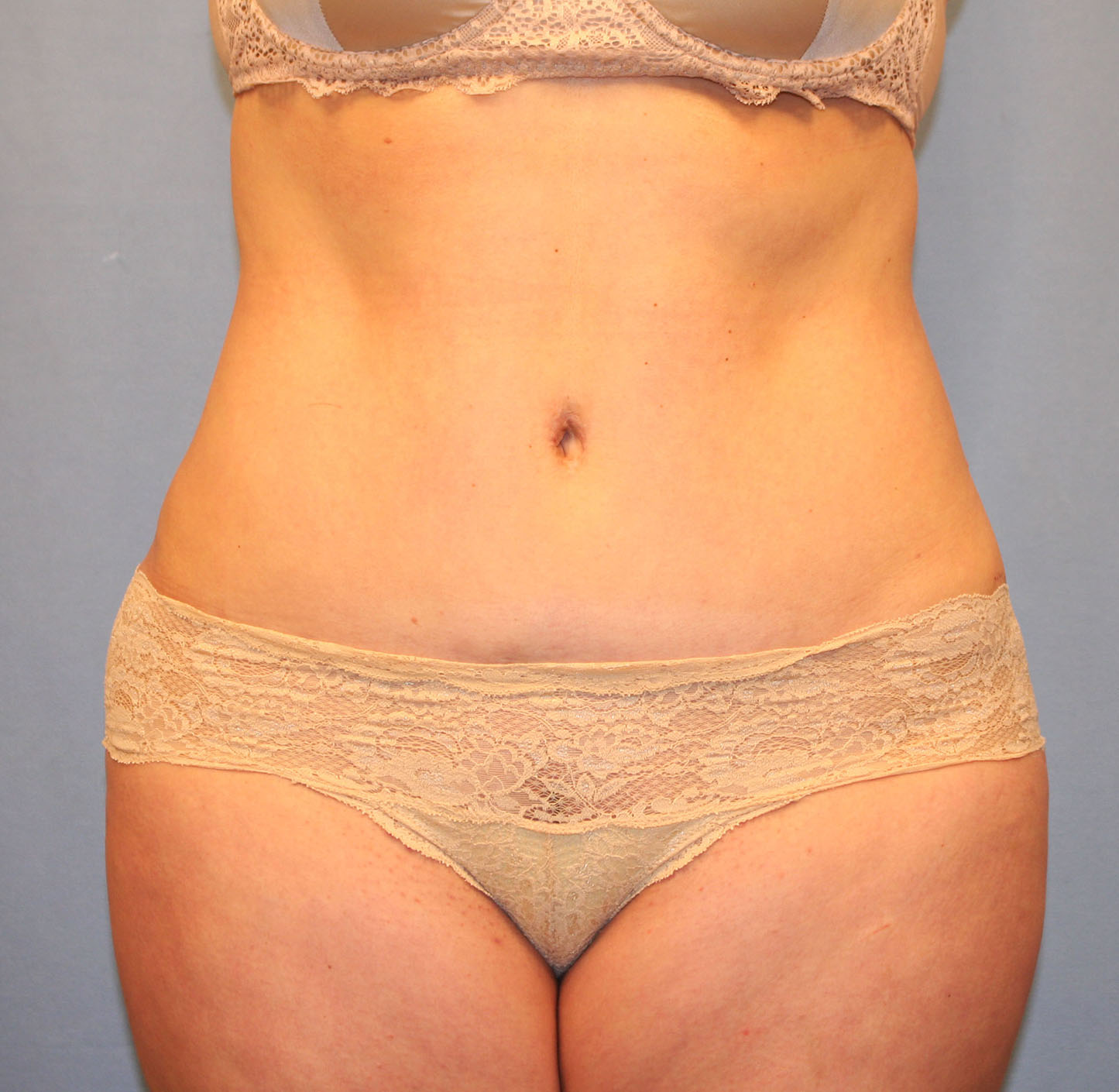 After Image: Tummy Tuck - front