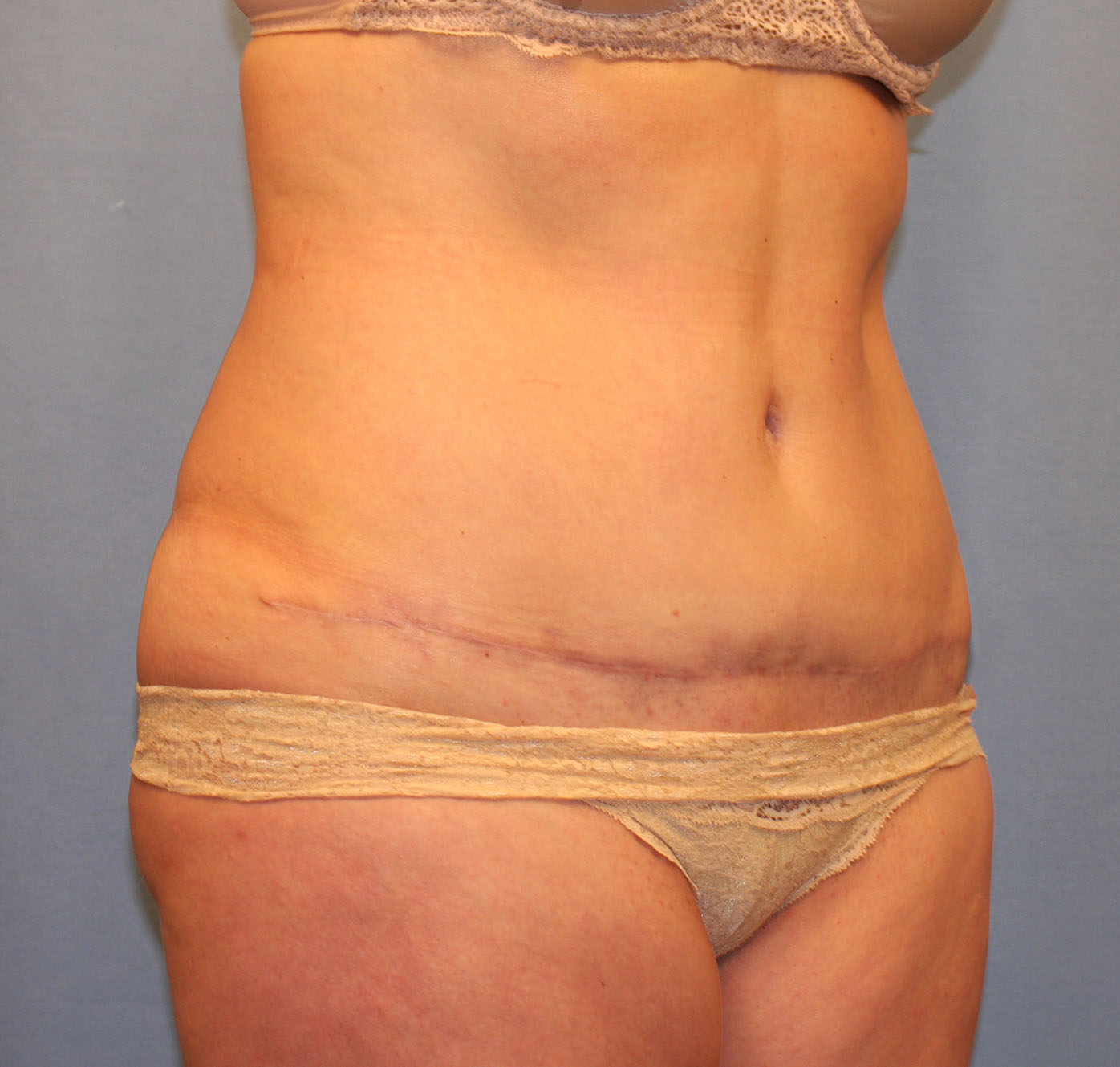 After Image: Tummy Tuck - right-front-oblique