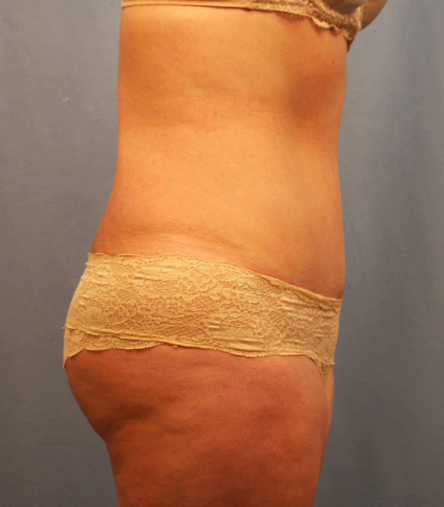 After Image: Tummy Tuck - right-side