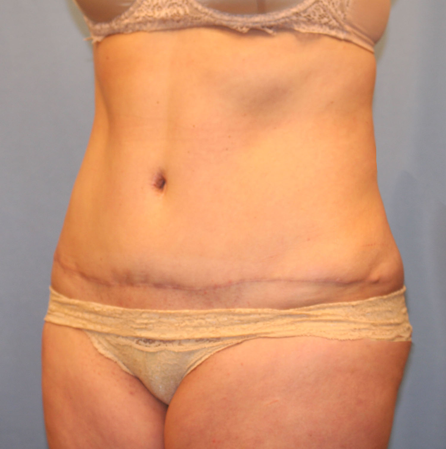 After Image: Tummy Tuck - left-front-oblique
