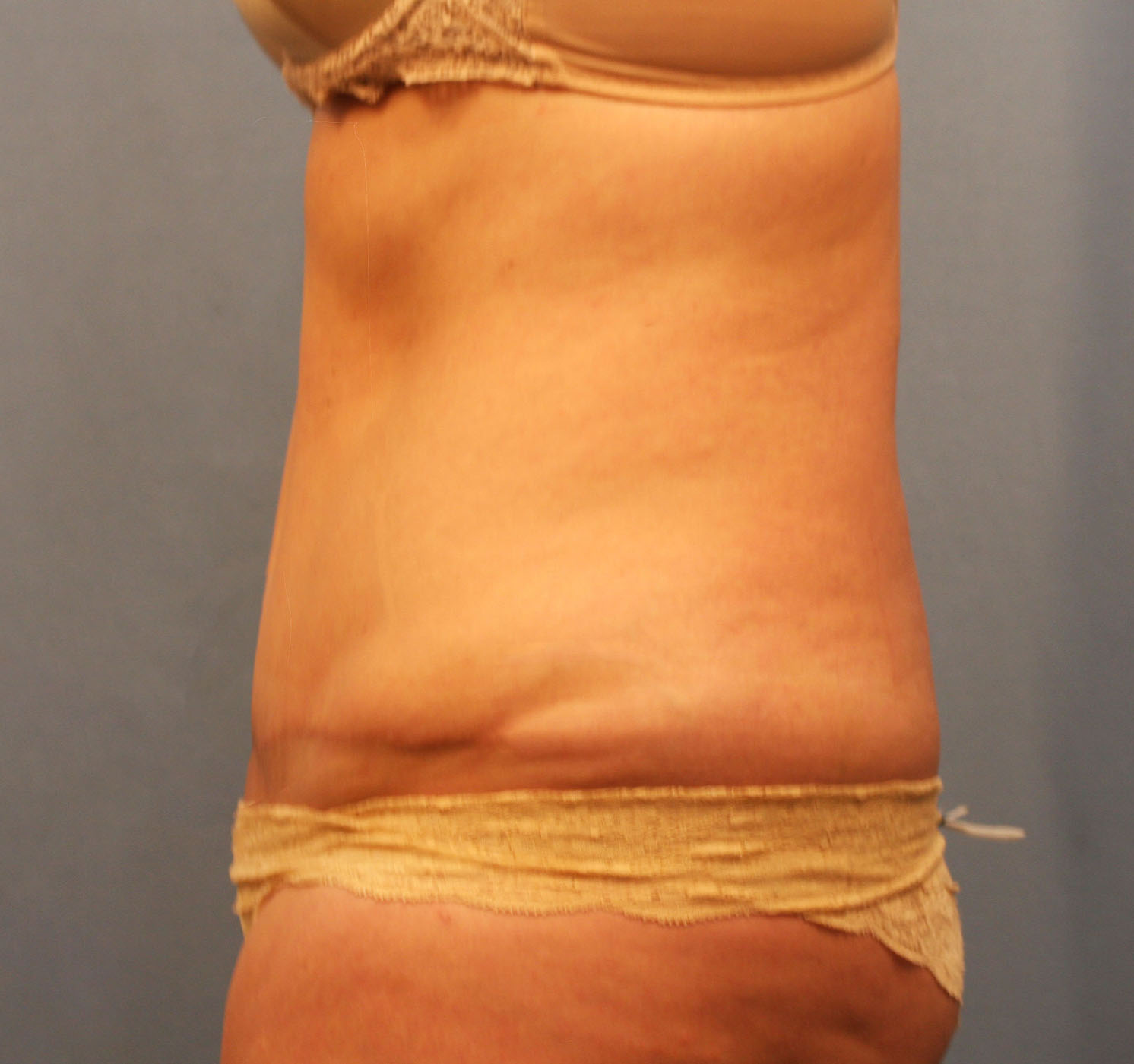 After Image: Tummy Tuck - left-side