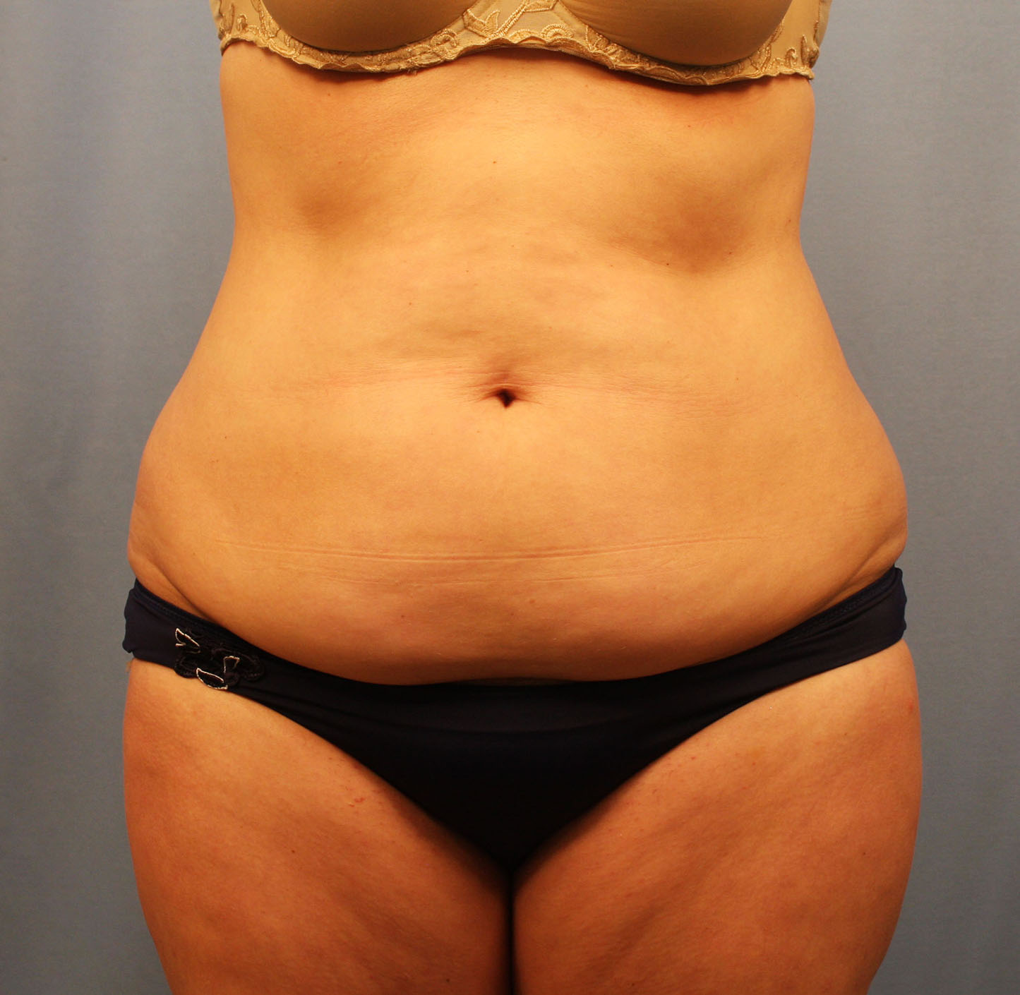 Before Image: Tummy Tuck - front