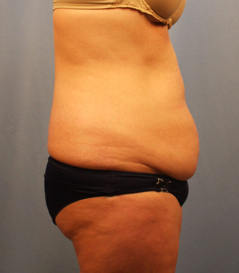Before Image: Tummy Tuck - right-side