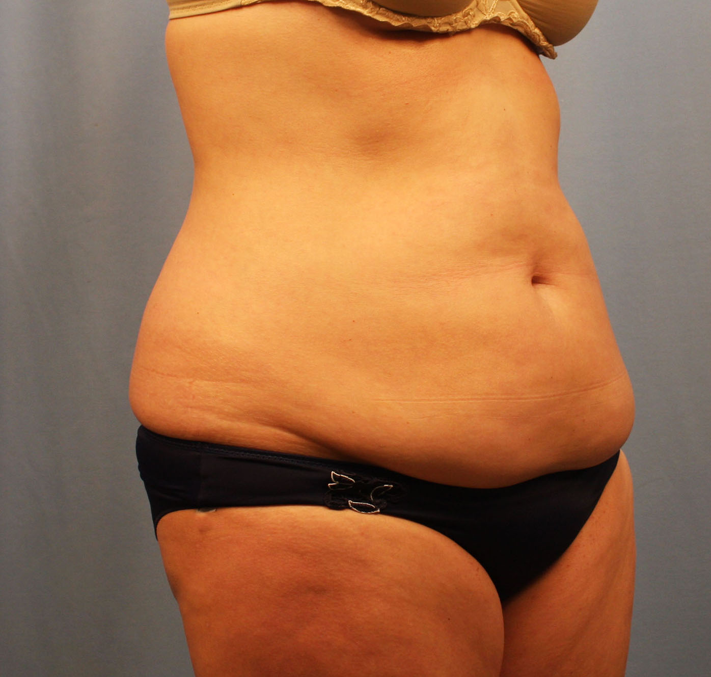 Before Image: Tummy Tuck - right-front-oblique