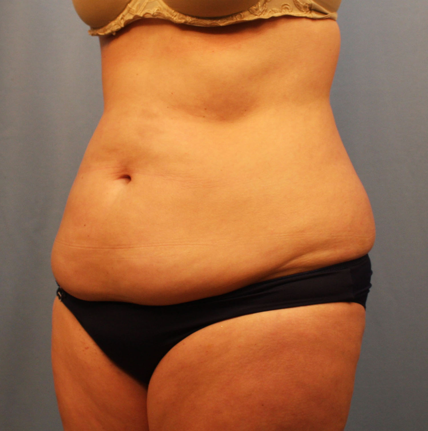 Before Image: Tummy Tuck - left-front-oblique
