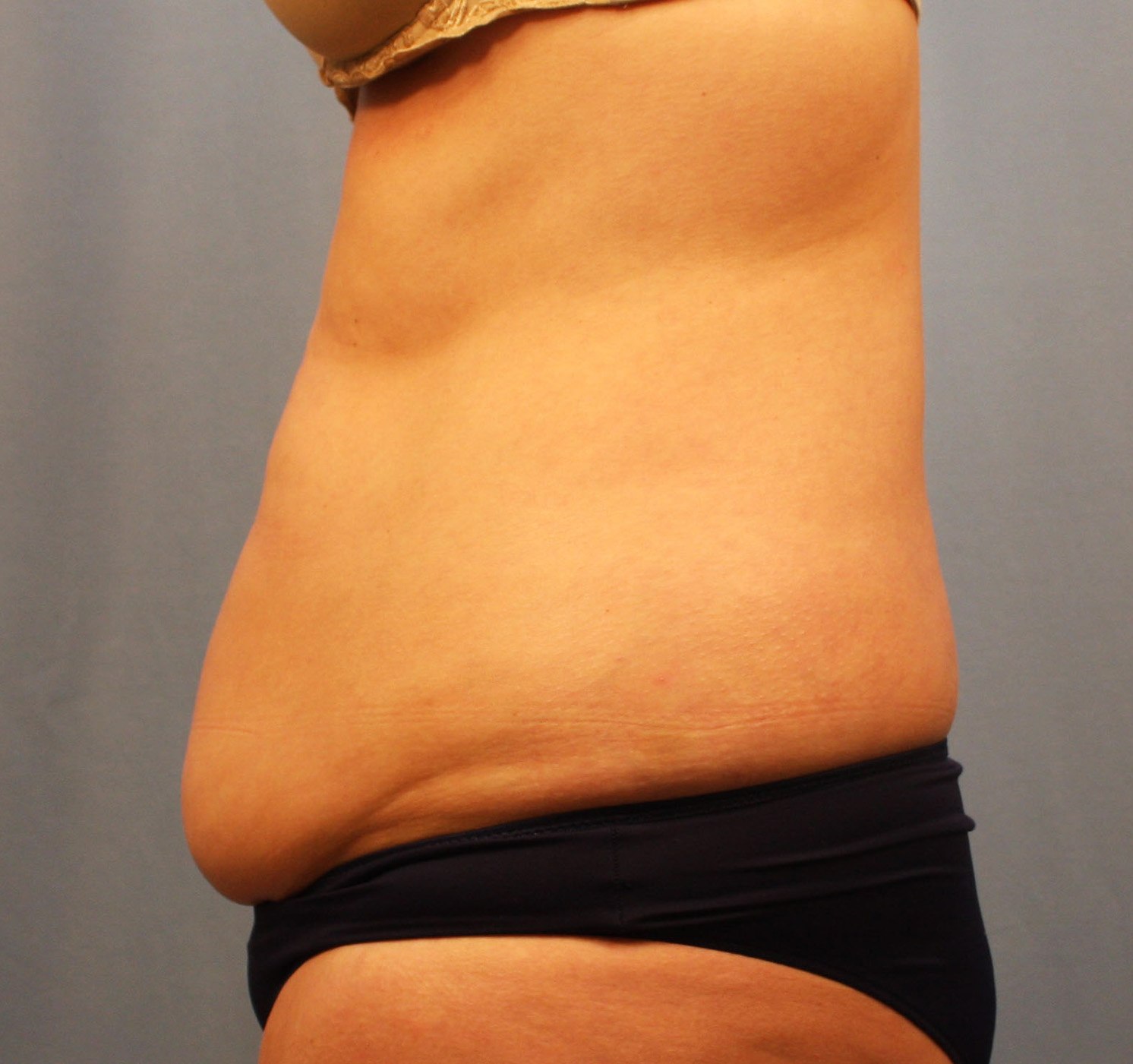 Before Image: Tummy Tuck - left-side