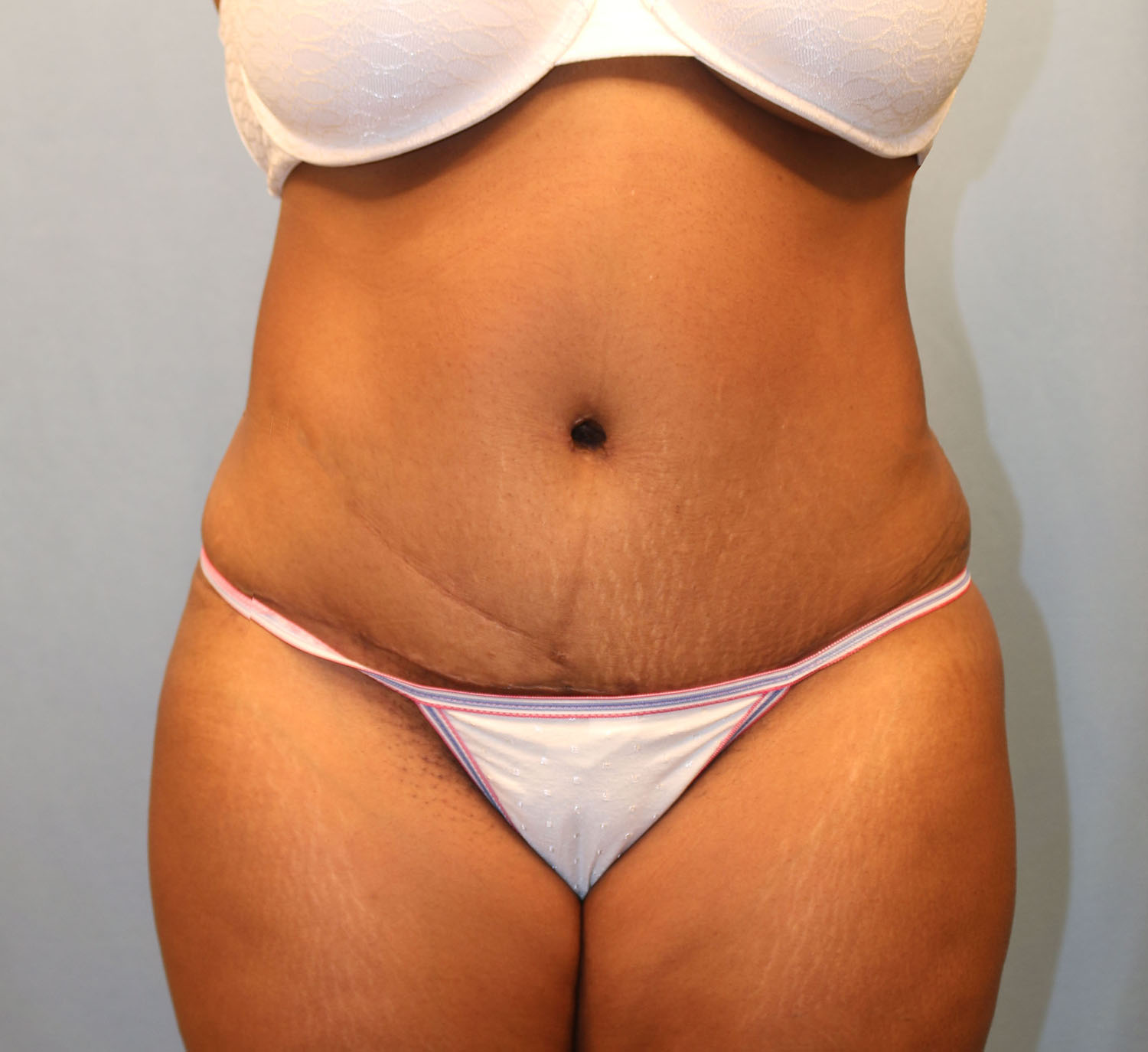 After Image: Tummy Tuck - front