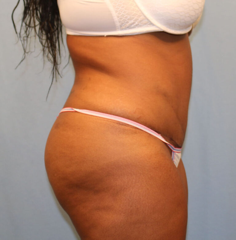 After Image: Tummy Tuck - right-side