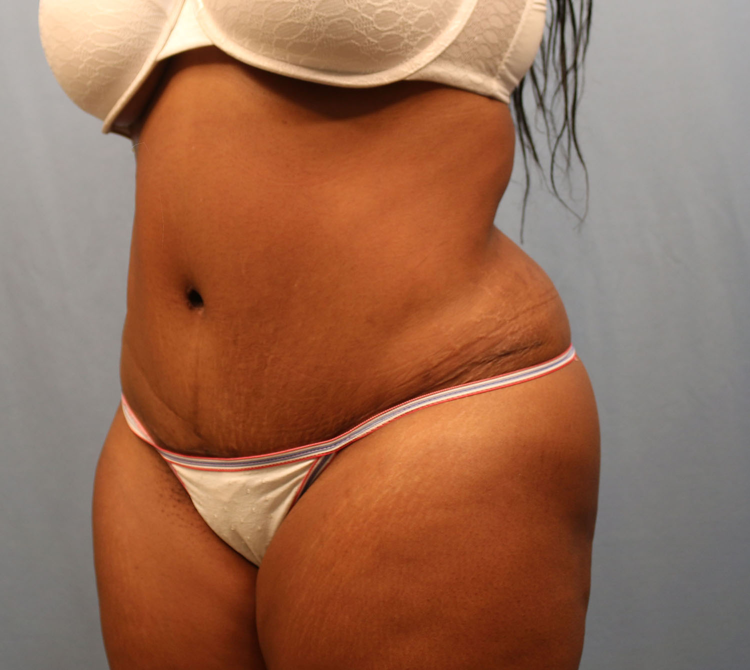 After Image: Tummy Tuck - left-front-oblique