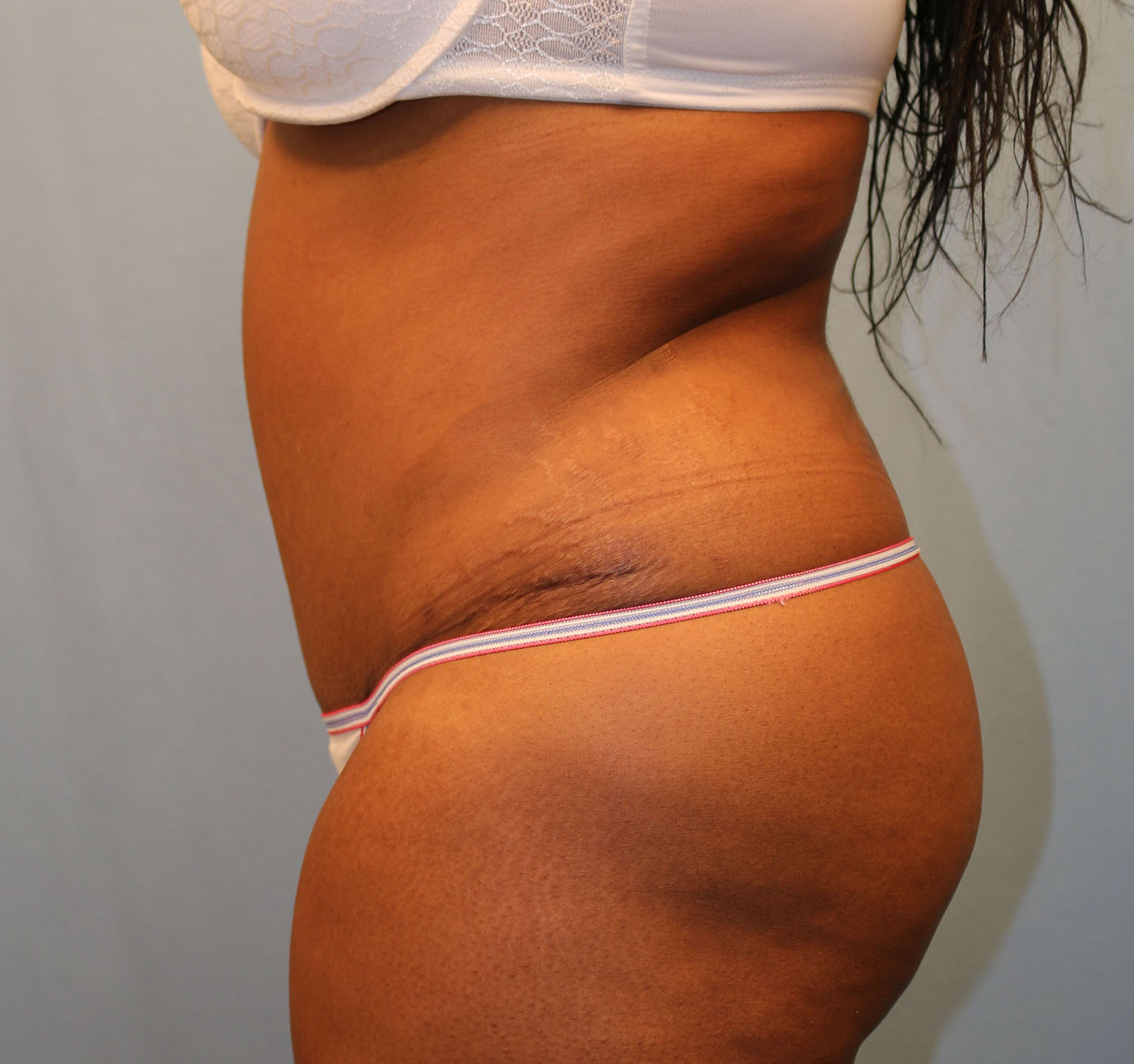 After Image: Tummy Tuck - left-side
