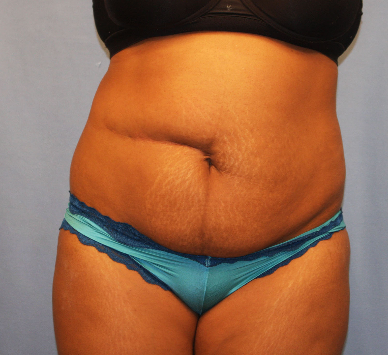 Before Image: Tummy Tuck - front