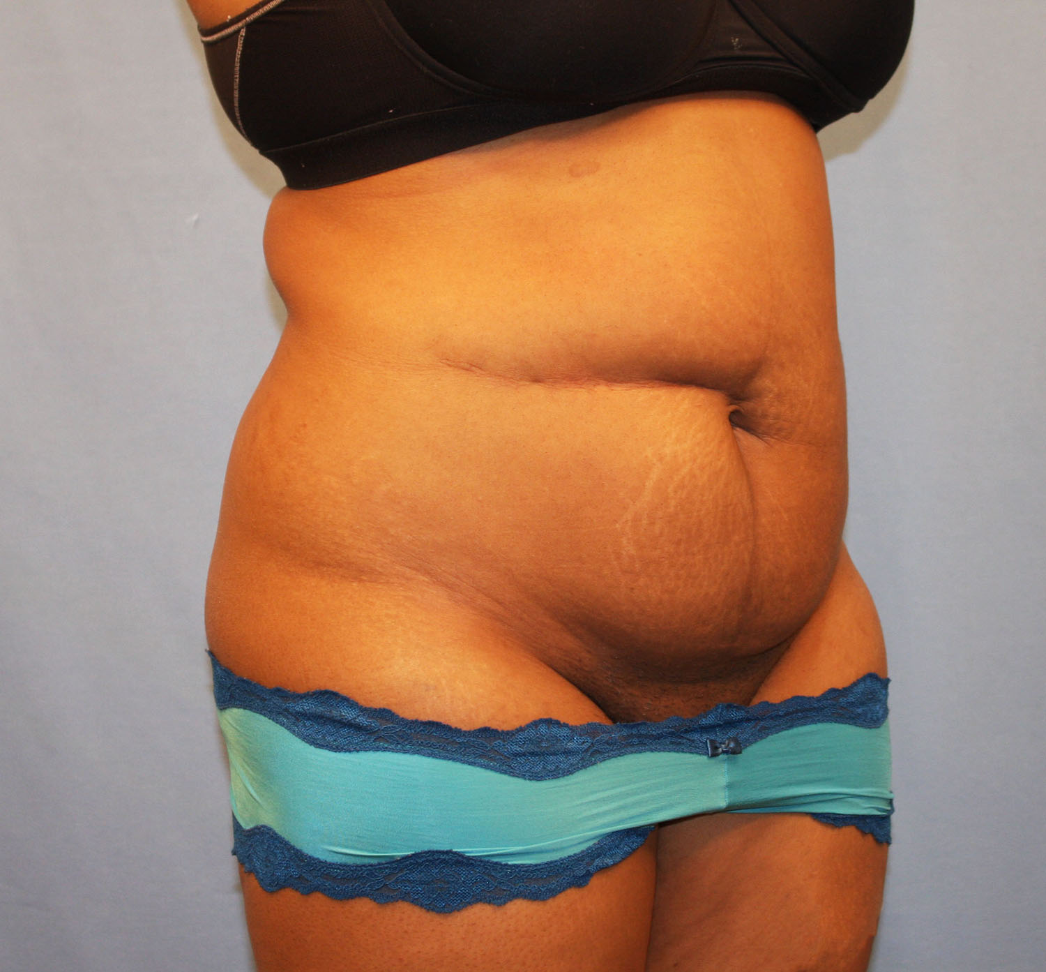 Before Image: Tummy Tuck - right-front-oblique