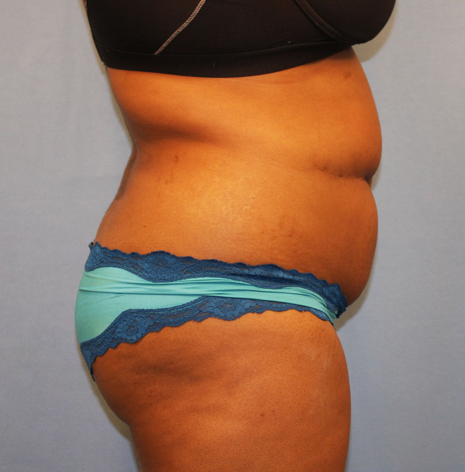Before Image: Tummy Tuck - right-side