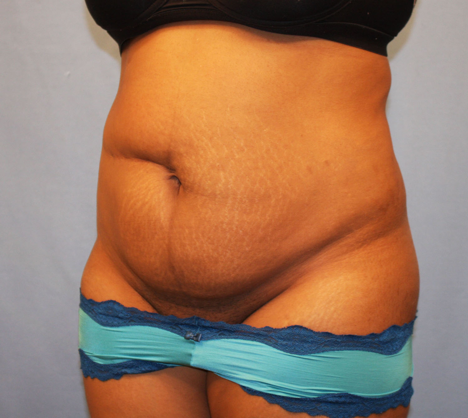 Before Image: Tummy Tuck - left-front-oblique