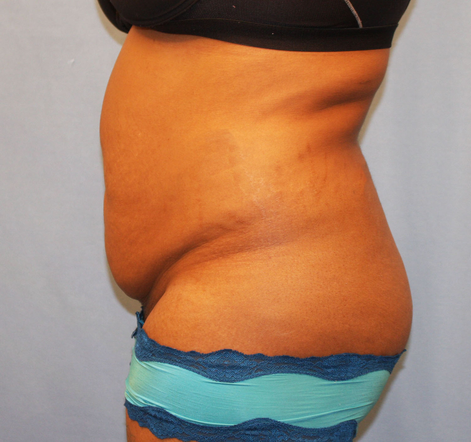 Before Image: Tummy Tuck - left-side