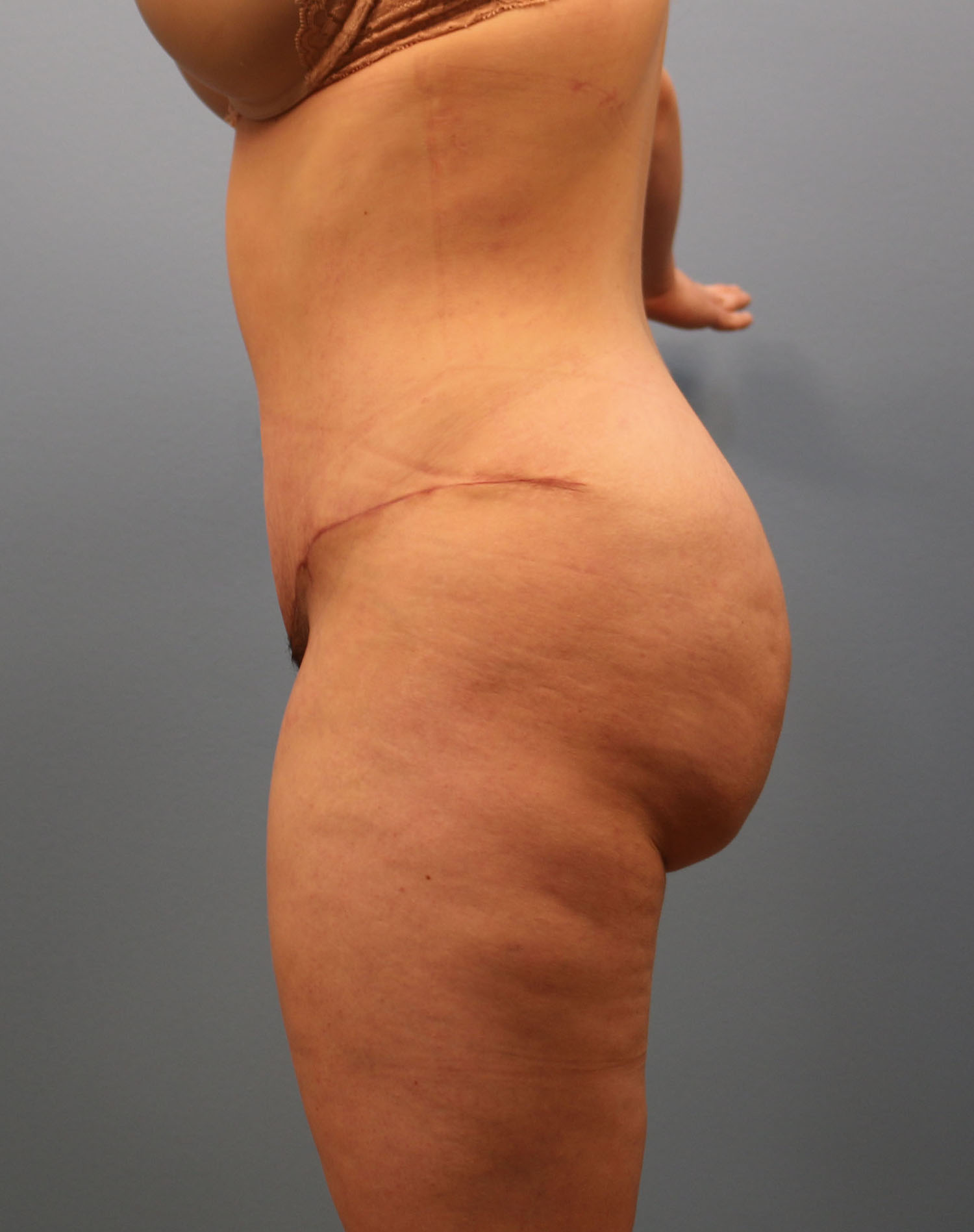 After Image: Tummy Tuck - left-side