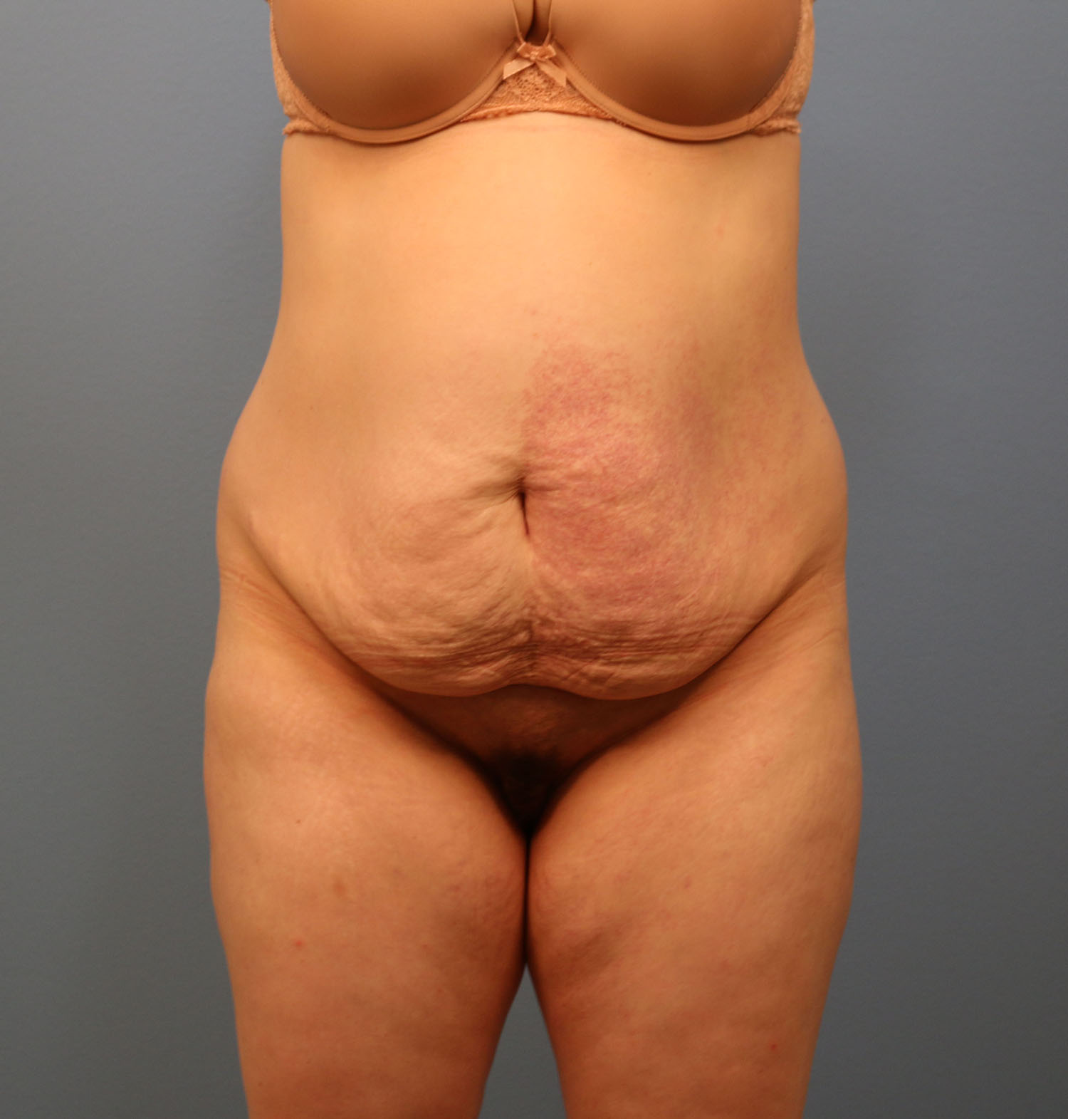 Before Image: Tummy Tuck - front