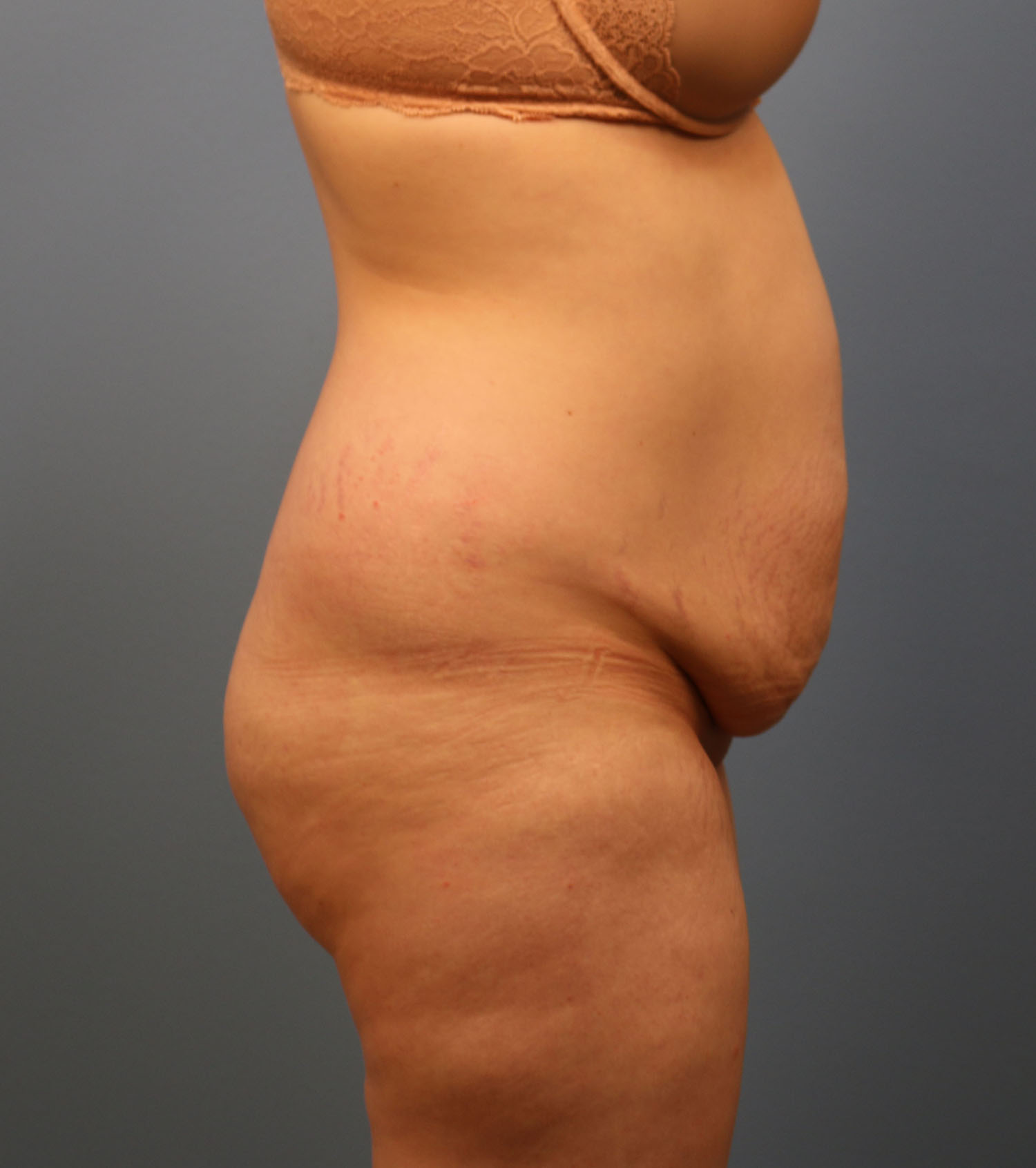Before Image: Tummy Tuck - right-side
