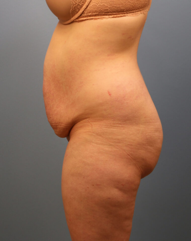 Before Image: Tummy Tuck - left-side