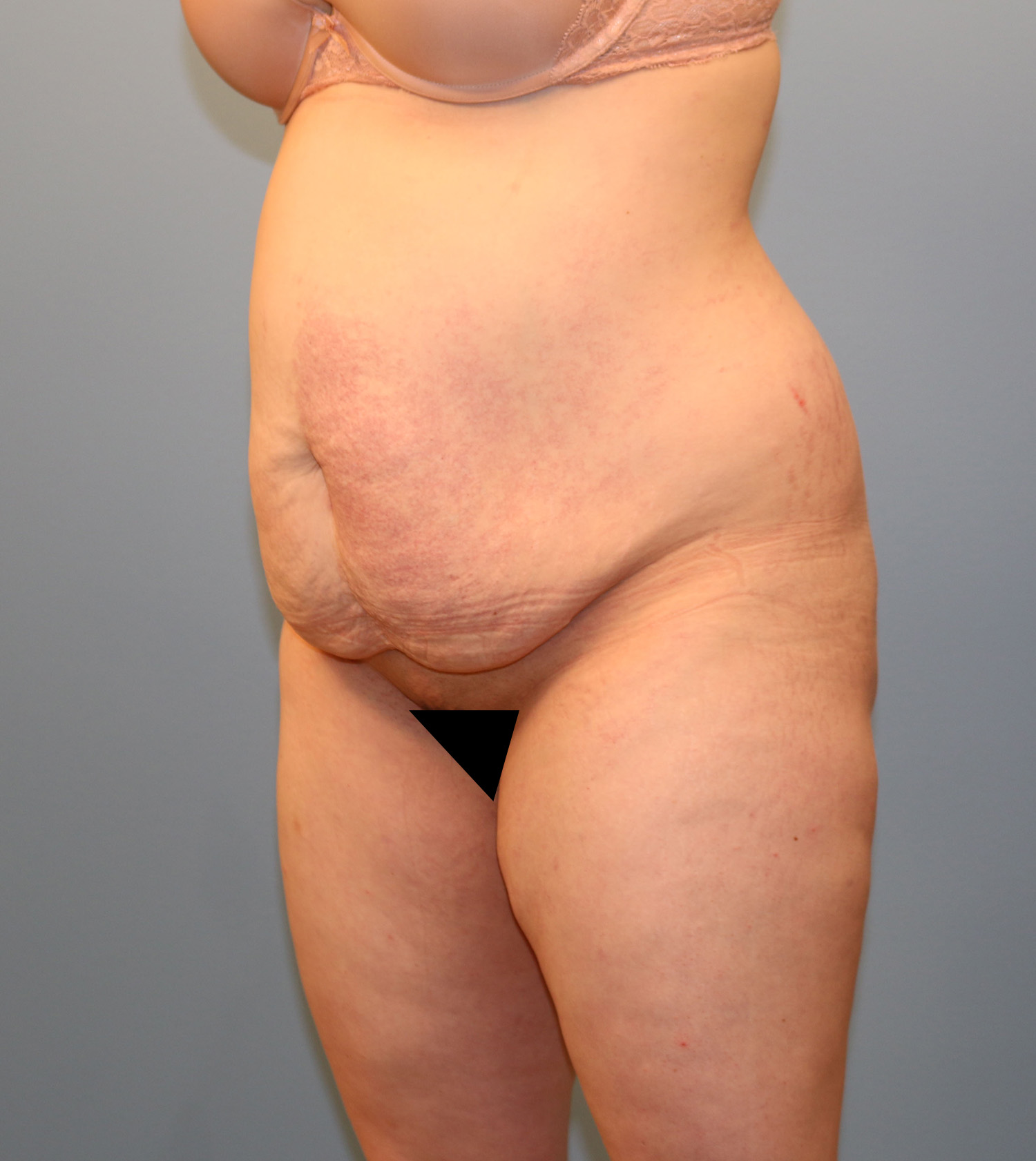 Before Image: Tummy Tuck - left-front-oblique
