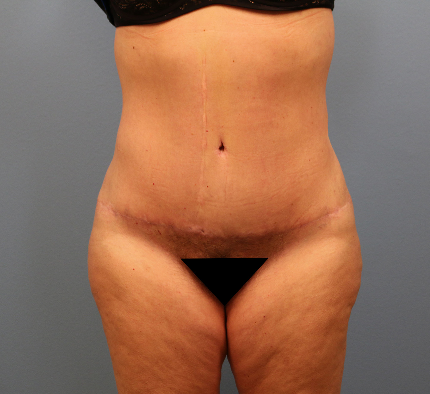 After Image: Tummy Tuck - front