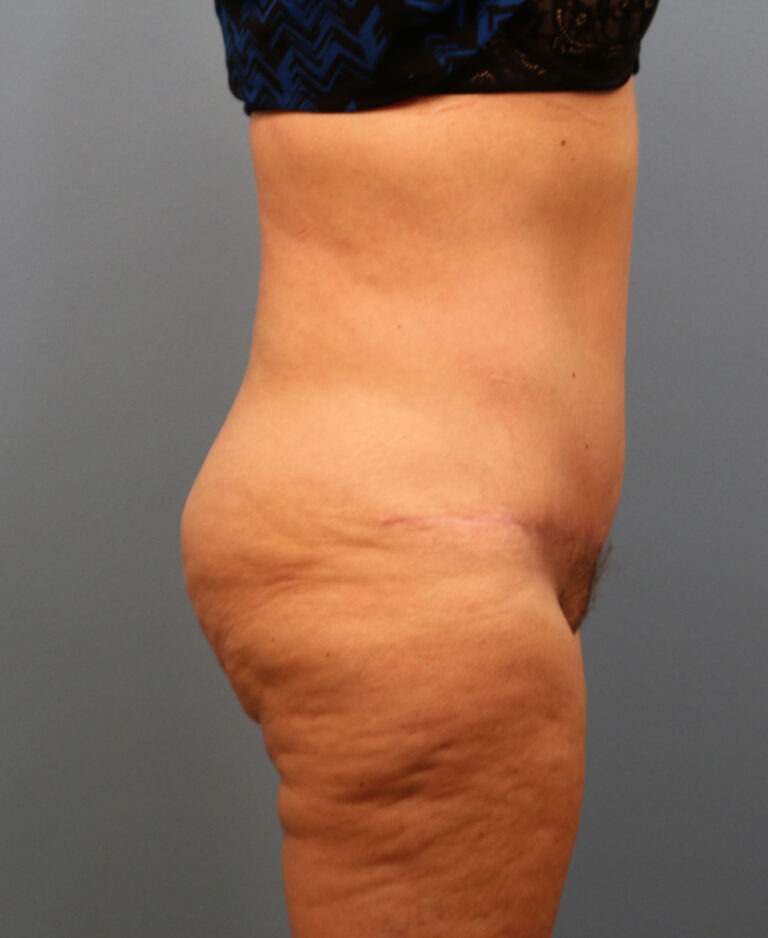 After Image: Tummy Tuck - right-side