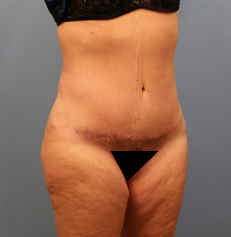 After Image: Tummy Tuck - right-front-oblique