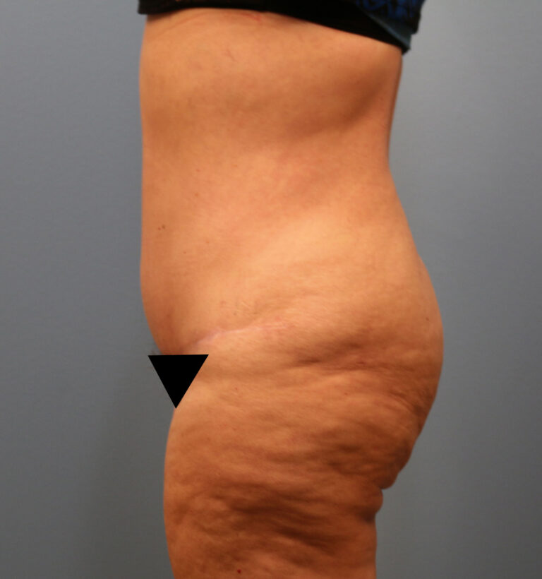 After Image: Tummy Tuck - left-side