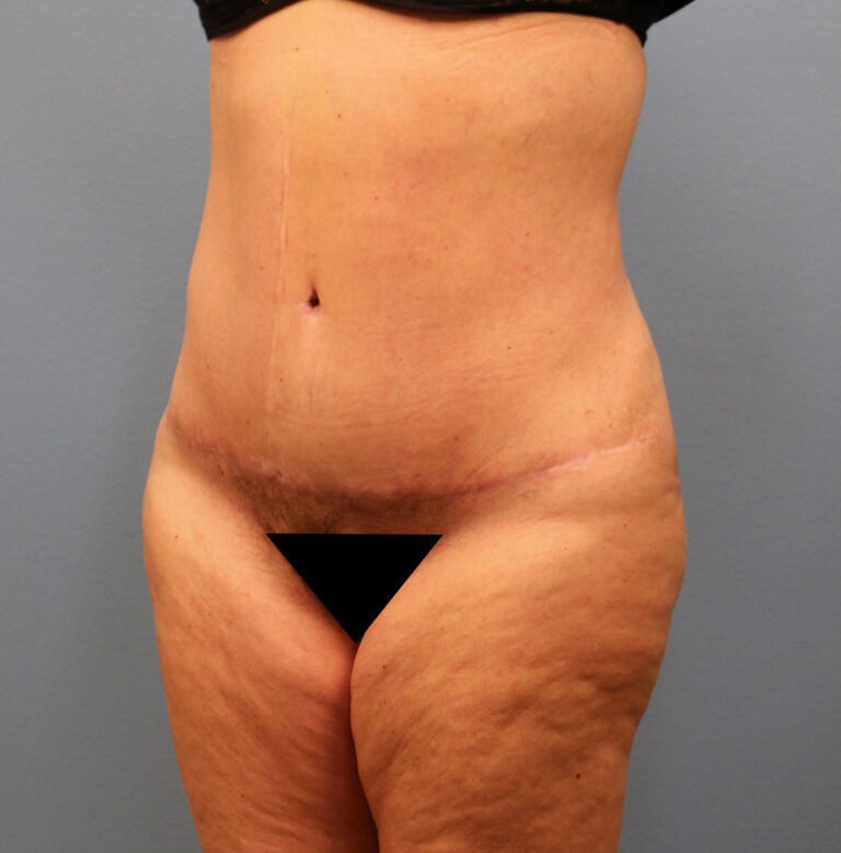 After Image: Tummy Tuck - left-front-oblique