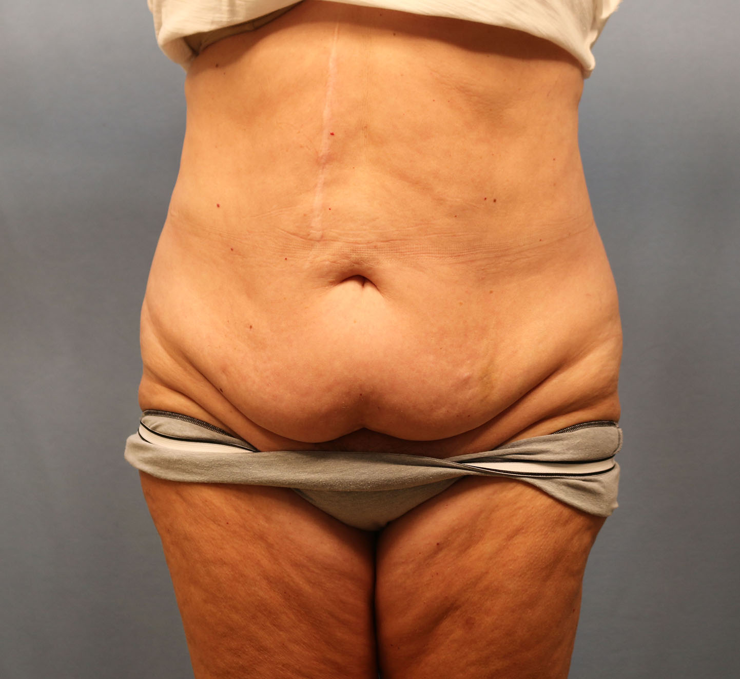 Before Image: Tummy Tuck - front