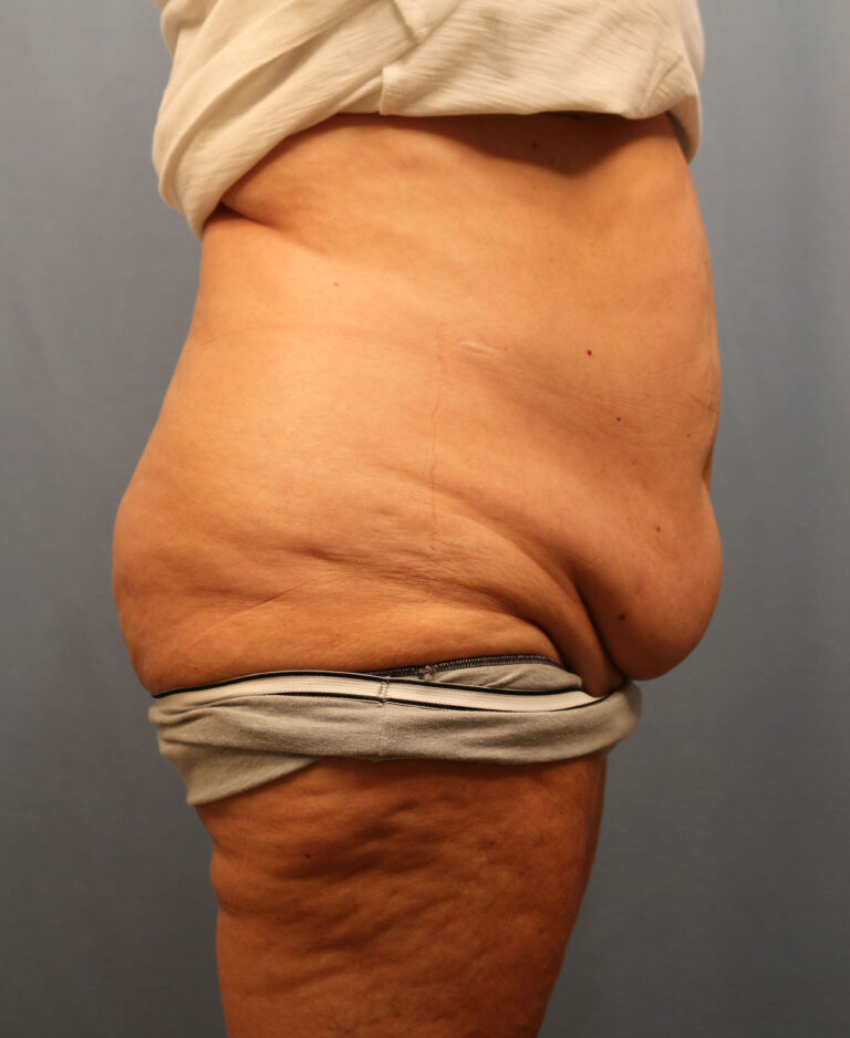 Before Image: Tummy Tuck - right-side