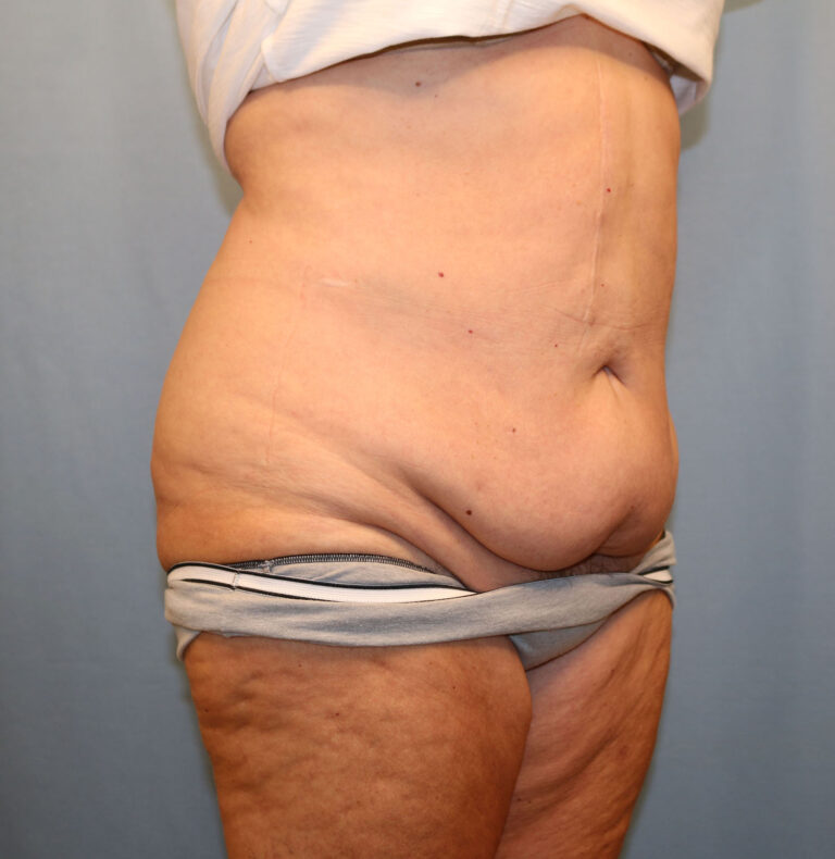 Before Image: Tummy Tuck - right-front-oblique