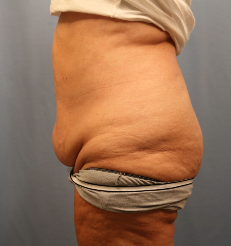 Before Image: Tummy Tuck - left-side